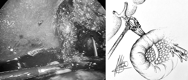 Stent in CBD