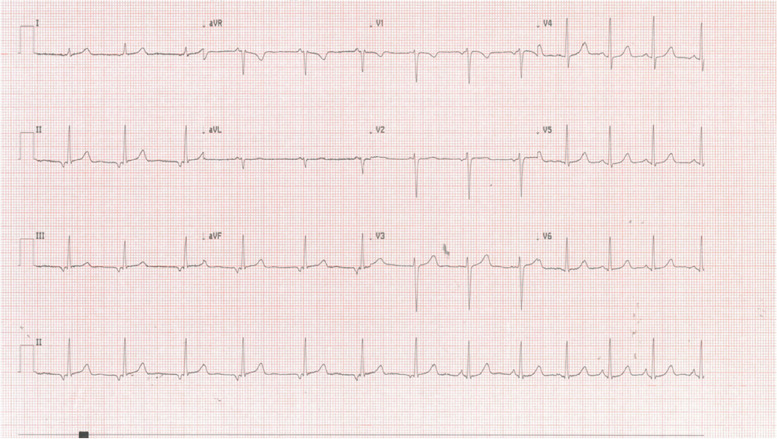 One of the several ECG showing a wandering pacemaker with a low atrial rhythm (also known as coronary sinus rhythm). We speculate that this resting ECG suggests a tonically active parasympathetic status on the conduction system of the heart