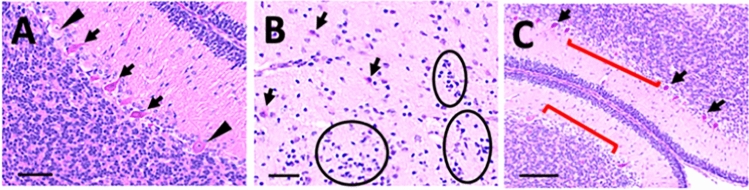 Prenatal THC exposure results in ischemic histopathologic changes in the fetal brain in a rhesus macaque model. Representative images of H&E stained fetal brain sections. (A) Cerebellum with acute ischemic changes demonstrated by shrunken, hypereosinophilic Purkinje cells with dark, shrunken nuclei (arrows). Intact Purkinje cells have lighter, less pink cytoplasm and large nuclei with prominent nucleoli (arrowheads).Magnification bar = 50 μm. (B) Parietal white matter with reactive astrocytes and microglial activation, Magnification bar = 50 μm.Representative reactive astrocytes demonstrate prominent cytoplasm and fibrillary processes (arrows). Representative microglial clusters consist of groups of haphazardly arranged small, elongated, angular to irregularly shaped nuclei (encircled). (C) Cerebellum with acute Purkinje cell death (arrows) and focal Purkinje cell dropout (red bracket), indicating earlier cell death, Magnification bar = 100 μm.