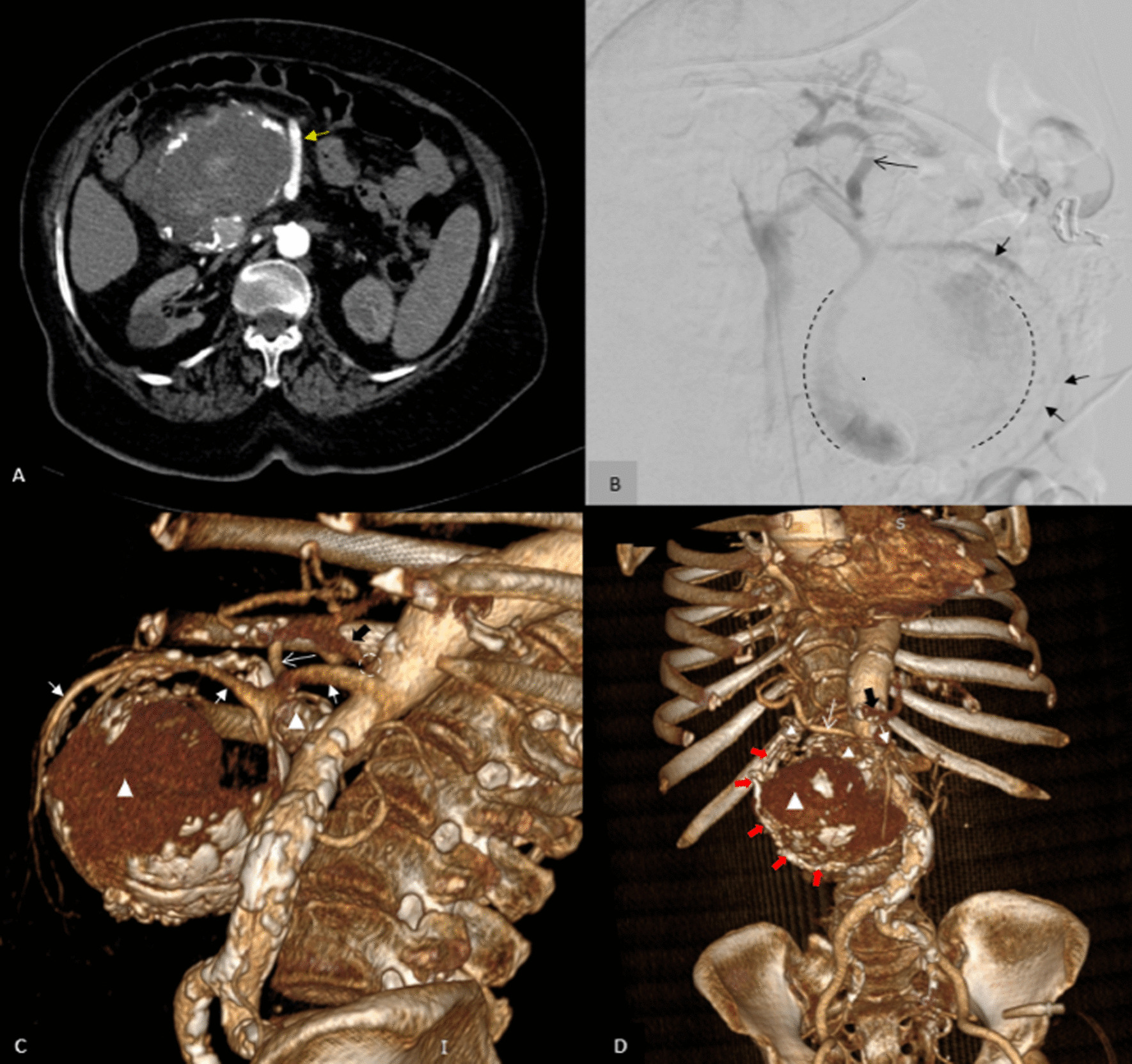 A The yellow arrow in the axial plane of computed tomography angiography indicates superior mesenteric artery, which continues its course to branches to supply small bowel. B Conventional angiography. Huge aneurysm originating from posterior and inferior surface of the proximal of superior mesenteric artery is seen in the lateral view of the superior mesenteric artery angiogram. The margin of this aneurysm is shown by the black dashed line. Short black arrows indicate the superior mesenteric artery itself, which is continuously branched in front of this aneurysm. A long black arrow indicates the right hepatic artery originating from superior mesenteric artery. C, D Reconstructed volume rendering images. White arrowheads point to three aneurysms, and short white arrows indicate superior mesenteric artery and its branches. Long white arrow indicates the right hepatic artery originating from superior mesenteric artery. Solid red arrows indicate anterior pancreaticoduodenal artery’s course which originates superiorly from gasrtoduodenal artery and is connected inferiorly to the huge aneurysm. A solid black arrow indicates the celiac trunk. The dotted circle shows obvous narrowing of the origin of the celiac trunk