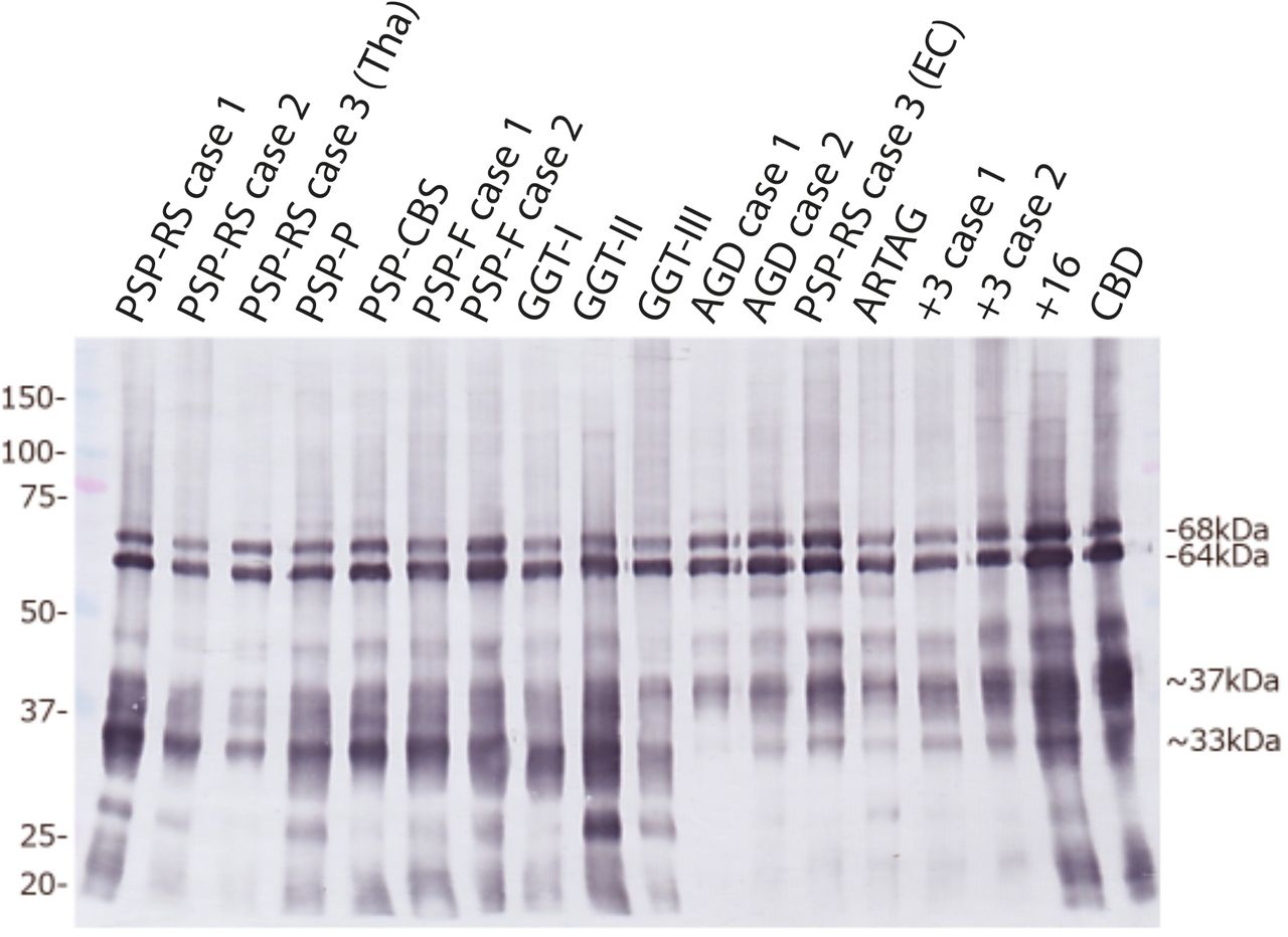 Immunoblot analysis of 4R tauopathiesHyperphosphorylated full-length tau (64 and 68 kDa) and C-terminal fragments (33 kDa and 37 kDa) were detected in sarkosyl-insoluble fractions from the brain regions used for cryo-EM by anti-tau antibody T46. A prominent 33 kDa band was characteristic of PSP and GGT; strong 37 kDa bands were in evidence in AGD, ARTAG, cases with intron 10 mutations in MAPT (+3 and +16) and in CBD. PSP-RS case 3 had a strong 33 kDa band in thalamus (Tha) and strong 37 kDa bands in entorhinal cortex (EC), consistent with AGD co-pathology.