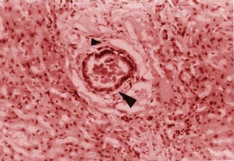 Periductal fibrosis-associated biliary thrombus (large arrow), mononuclear leukocytes and fibroblasts (small arrow).