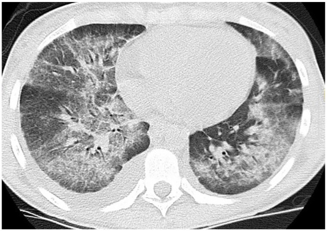 Bilateral ground glass patchy infiltrates with subpleural sparing and small right pleural effusion.