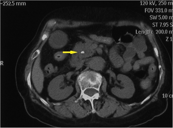 An abdominal computerized tomography (CT) scan demonstrating dilatation of the extrahepatic bile duct with a stone at the lower CBD