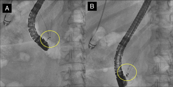 Initial scout film (A) questionable linear object in the right upper quadrant (B) possible filling defect in the lower third of the biliary tree.