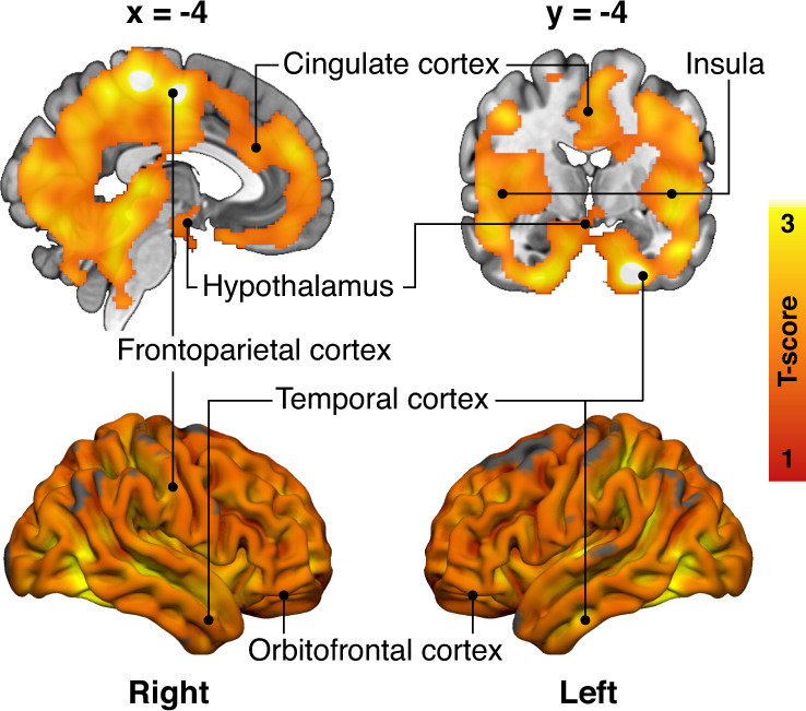 Obesity risk and brain glucose uptake.Brain regions where the high-risk subjects (n = 19) had increased brain glucose uptake (BGU) compared with the low-risk subjects (n = 19) while controlling for age. The data are thresholded at p < 0.05, FWE corrected at cluster level. T-score from the two-sample t-test is shown in red-to-yellow scale.