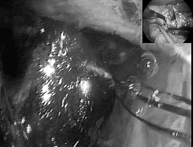 TIA access to CBD, stone impacted in CBD retrieved by choledochoscopy
