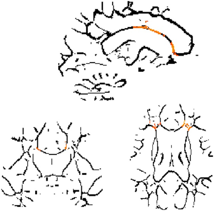 Voxels in which fractional anisotropy (FA) values are significantly linked to shorter mean Stroop times, indicating better performances, in the substance use disorder (SUD) group. Legend: Results of the GLM whole brain analysis using the function randomize from FSL toevaluate the link between FA values in participant's skeletons and their mean Stroop Timeduring the week. Significant voxels are highlighted in orange and negatively linked to theStroop Time, indicating that higher FA values is linked to better inhibition performance.