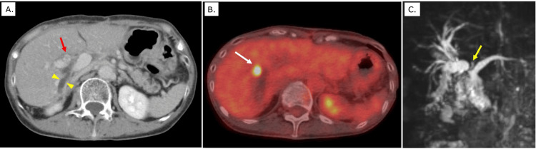 Imaging findings and preoperative simulation for intrahepatic cholangiocarcinomaA: Contrast-enhanced computed tomography (CT) demonstrates dilation of the right intrahepatic bile duct (yellow arrowhead) and a soft-tissue density adjacent to the jejunal anastomosis (red arrow).B: Positron emission tomography–CT (PET-CT) reveals nodular fluorodeoxyglucose (FDG) uptake within the soft-tissue lesion near the anastomosis (white arrow), suggestive of malignancy.C: Magnetic resonance cholangiopancreatography (MRCP) shows dilation of the right intrahepatic bile ducts with a filling defect between the bile ducts and the anastomosed jejunal limb (yellow arrow).