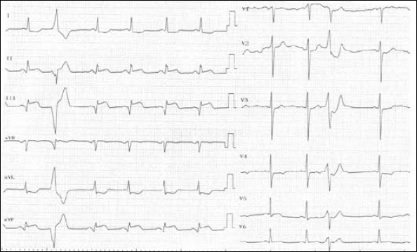 ST elevation in inferior leads on 12-derivation ECG obtained in the emergency department