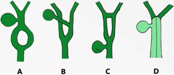 Unclassified reported variants. A Variant described by Paraskevas et al. [8]. B Variant described by Kosar et al. [9]. C Variant described by Nuamah et al. [10, 11]. D Variant described in our report