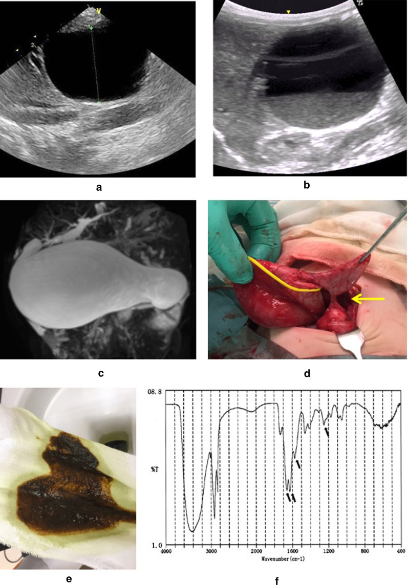 Data of Case 1. a Ultrasonography on day 2 showed a large choledochal cyst but no debris. b Ultrasonography on day 45 revealed debris in the cyst. c, d Magnetic resonance imaging and surgical findings confirmed a huge cyst and a narrow segment (arrow). e, f Infrared absorption spectra of the debris. Four major absorption bands (arrows) were characteristic of calcium bilirubinate