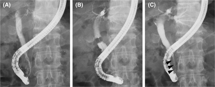 The findings of the second endoscopic cholangiography. A, No stones in the common bile duct (CBD) were observed. B, After the covered self‐expandable metallic stent was removed, the biliary sludge was removed by a balloon catheter. C, It was confirmed that the stricture of distal CBD was improved to some extent (arrowhead)