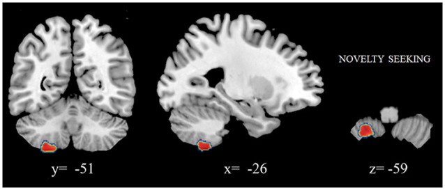 Positive association between cerebellar gray matter volumes and NS scores. Coordinates are in Montreal Neurological Institute (MNI) space. In figure left is left.