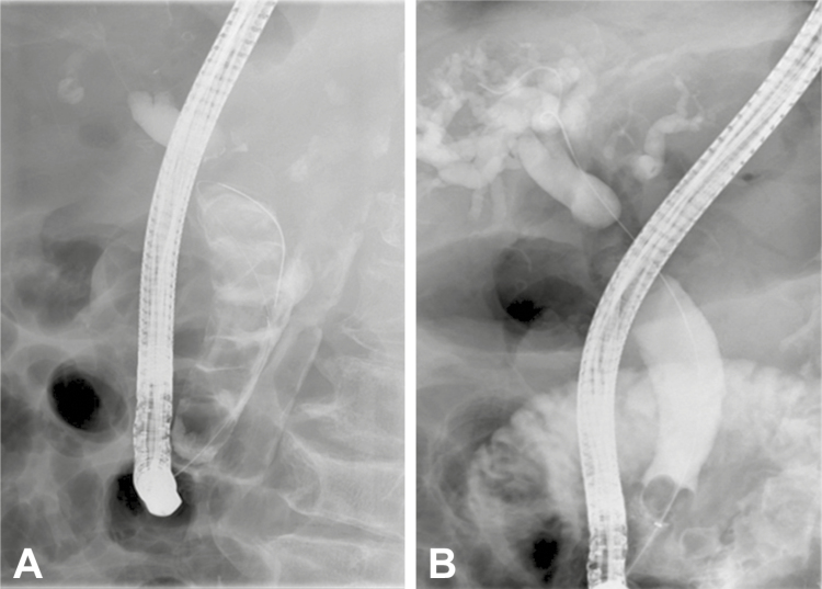 ERCP images of the common bile duct before (A) and after (B) extraction of multiple stacked stones with complete clearance of CBD.