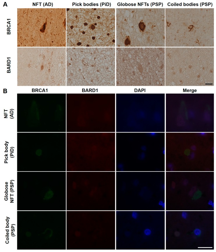 Immunohistochemical (A) and immunofluorescence double staining (B) studies using antibodies against BRCA1 and BARD1 in human tauopathies. (A) Cytoplasmic BARD1 positivity resembling tau aggregates was not observed in AD, PiD, or PSP brain samples. (B) BARD1 did not colocalize with BRCA1 in the cytoplasm and showed weak positivity in the nucleus. NFT, neurofibrillary tangle. The scale bars represent 20 µm in both A and B.