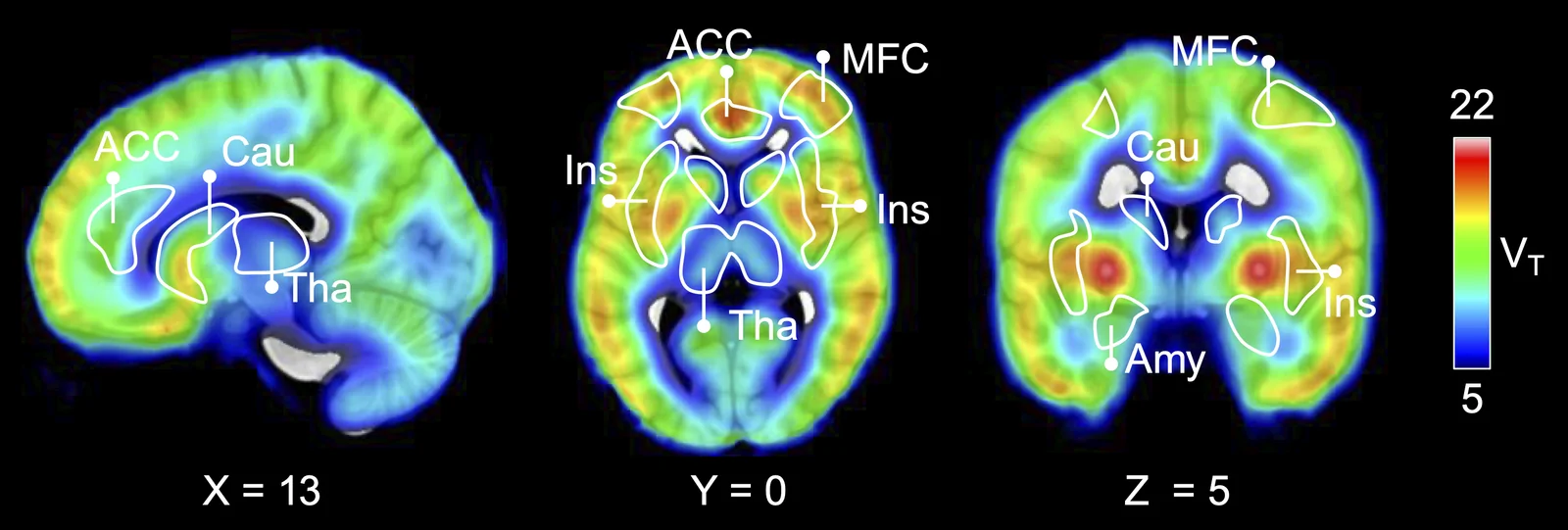 Three PET brain slices (sagittal X=13, axial Y=0, coronal Z=5) showing distribution volume V sub T. Labels include ACC, Cau, Tha, MFC, Ins, and Amy, with higher V sub T in cortical and central areas.