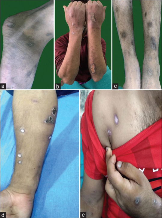 Deep circular punched-out looking atrophic scars formed due to heroin administration by intradermal, subcutaneous, or intramuscular routes (skin popping). (a-e)
