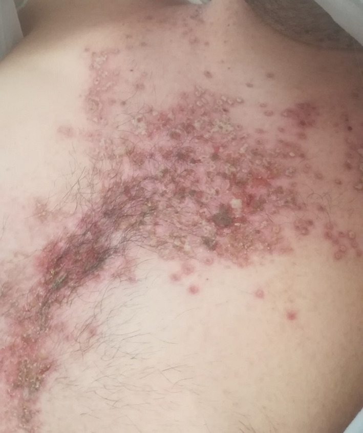 Vesico‐pustular eruption involving chest