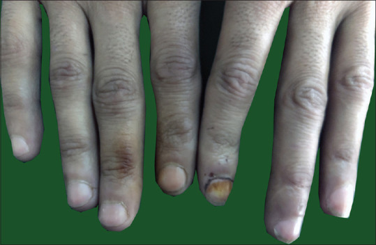 Staining of the fingers and nails with resulting hyperpigmentation seen in majority of cannabis smokers