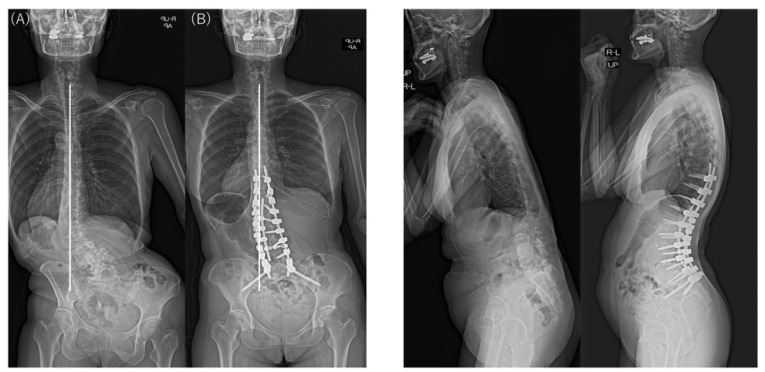 Preoperative and postoperative standing radiographs showing coronal and sagittal correction using anteroposterior staged surgery for ASD in a 55-year-old woman with type 2 CM. CBD changed from –86.7 mm preoperatively (A) to –38.8 mm postoperatively (B), with the C7 plumb line on the same side as the CBD. Sagittal alignment improved significantly, but CBD remained at ≥20 mm postoperatively. CM, coronal malalignment; CBD, coronal balance distance.