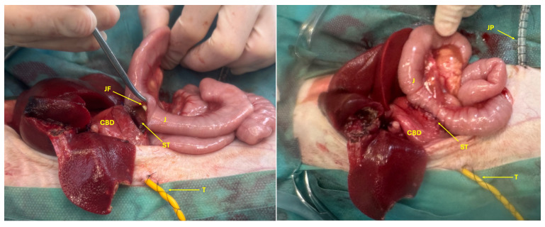 Choledochoenterostomy (ST) between the common bile duct (CBD) and jejunum (J) with the jejunal feeding tube (JF), choledochostomy tube (T), and the abdominal drain (JP).