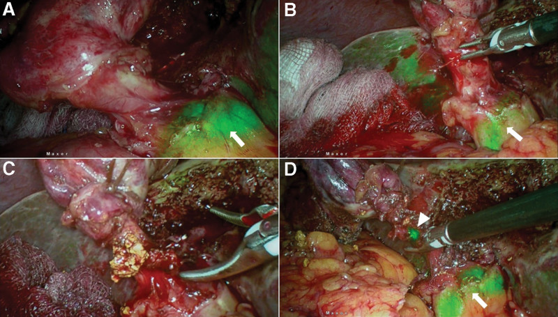 (a) ICGF after antegrade dissection of gallbladder, arrow showing CBD fluorescence, showing a wide cystic duct with suspicion of cystic duct calculi; (b) Bleeder from cystic ductotomy, arrow showing CBD fluorescence, CBD fluorescence not obscured with blood in field; (c) Stone milked out from cystic duct; (d) Arrow head showing fluorescent bile leak from ductotomy site after cystic ductstone clearance, arrow showing CBD fluorescence. CBD = common bile duct, ICGF = ICG fluorescence.