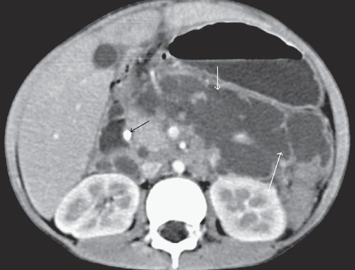 Transaxial contrast-enhanced CT scan shows a large, loculated retroperitoneal collection displacing the stomach anterosuperiorly (white arrows) with a pseudowall and septae and a calculus in the distal part of CBD (black arrow)
