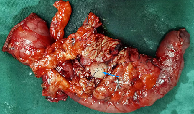 In situ, the neoplasm was located in the distal common bile duct, measuring approximately 2.2 cm × 1.8 cm in size, and exhibited clear boundaries.