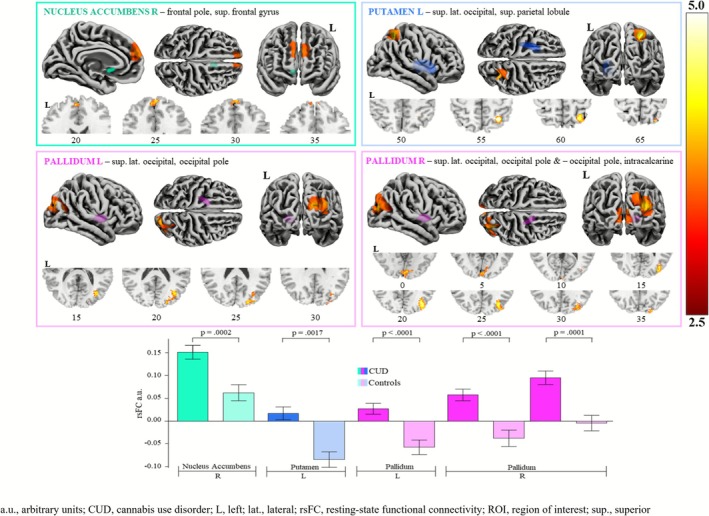 Significantly greater resting‐state functional connectivity in people with a cannabis use disorder compared to controls, between ROI seeds and clusters. a.u., arbitrary units; CUD, cannabis use disorder; L, left; lat., lateral; rsFC, resting state functional connectivity; ROI, region of interest; sup., superior.