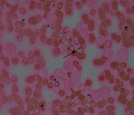 Bone marrow smear showing that about 10% of erythroid precursors are ring sideroblasts (arrow) (Perl's Prussian blue stain, ×1000).