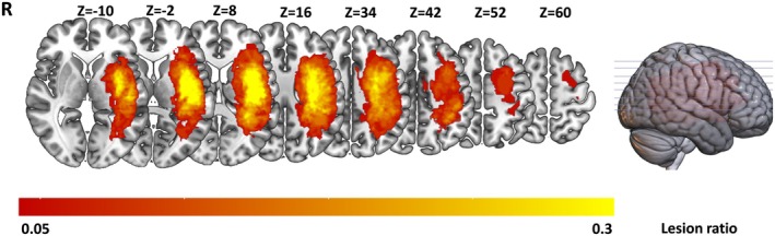 The lesion map represents data from 31 stroke patients, with the color bar indicating the number of subjects with lesions in each voxel. The Z‐axis ranges from Z = −10 to Z = 60 in MNI coordinates. R indicates the right hemisphere.