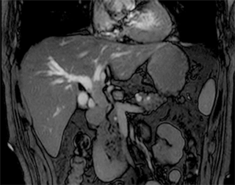 Magnetic resonance imaging revealed extensively dilated bile ducts due to an intraluminal lesion located in the common bile duct.