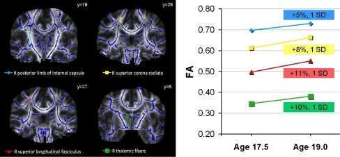 Clusters of significant change in the superior longitudinal fasciculus over time in adolescents age 17.5 to 19 (≥153 μl, p < .01; N = 22) (Bava et al. 2010a, b). Results are superimposed on a fiber skeleton (blue) and overlaid on a standardized template. Images are in radiological convention