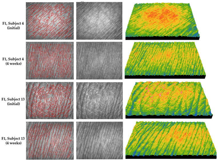 Representative images of skin topography recorded for formula F1 in subject no. 4 (age 24) and subject no. 13 (age 47) at baseline and after 4 weeks of treatment; the images include the wrinkle line map (left), grayscale images of the skin surface (middle), and 3D images of the skin microrelief (right).