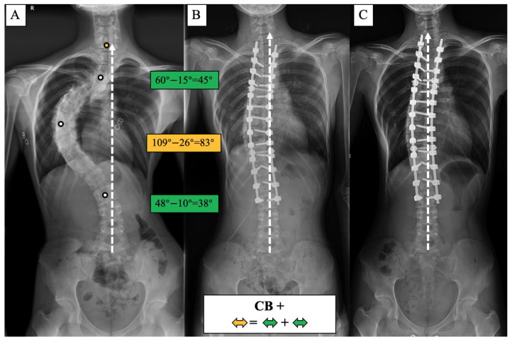 CB+ case, 25-year-old female AdIS patient ((A): preoperation, (B): postoperation, and (C): 3-year follow-up). The main thoracic curve was corrected from 109° to 26° (83° correction). The upper thoracic curve was corrected from 60° to 15° (45° correction), and the thoracolumbar curve was corrected from 48° to 10° (38° correction). The correction rate of the main curve matched the compensatory curves, and the coronal plane balance was maintained after surgery and long-term follow-up.