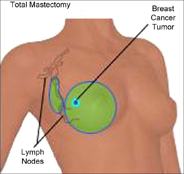 Modified radical mastectomy
