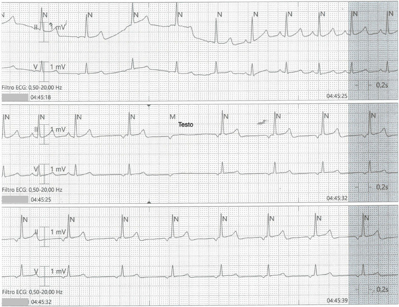 Wandering pacemaker followed by a blocked atrial wave at telemetry, occurred while the patient was sleeping (04.45 am)