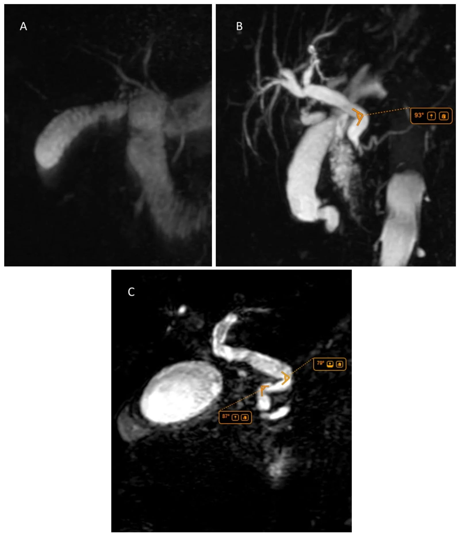 MRCP images illustrating CBD tortuosity grades: (A) grade 0, (B) grade 1, and (C) grade 2.