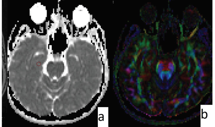 Male, 22 years old, SC addict. ADC map (a) and FA map (b) can be seen. ROI was placed on the right hippocampus. ADC value is 893; FA value is 231 (significantly lower than the control group).