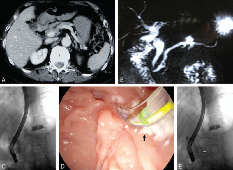Abdominal CT (A) and MRCP (B) revealed pneumobilia, choledocholithiasis, and dilatation of the CBD stump and MPD. C, ERCP showed separate openings of the CBD and MPD, and balloon in the CBD stump pulling out through the sphincterotomy. D, Endoscopy revealed that white crushed stones were removed from the CBD stump. E, Cannulation proceeded easily from MPD to CBD through a variant pancreatic duct (see arrow). CBD = common bile duct, CT = computer tomography, ERCP = endoscopic retrograde cholangiopancreatography, MPD = main pancreatic duct, MRCP = magnetic resonance cholangiopancreatography.