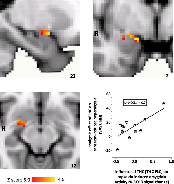 Region-of-interest analyses revealed that the main effect of delta-9-tetrahydrocannabinol (THC) was to significantly increase blood-oxygen-level-dependent (BOLD) response within the right amygdala (37 significantly activated voxels; Montreal Neurological Institute [MNI] coordinates of peak voxel 26, 0, −14; z score = 3.23). The coloured bars represent the range of z scores. MNI coordinates are indicated at the bottom right of each slice. The graph shows that in individuals, analgesic effect of THC on the unpleasantness of hyperalgesia was positively and significantly correlated with the effect of THC compared to placebo (PLC) on capsaicin-induced responses in the right amygdala (P < 0.01, r = 0.72). VAS, visual analogue scale.