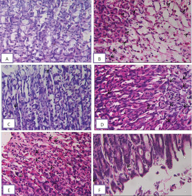 Representative photomicrographs of section of rat gastric mucosa after treatment with (A) vehicle no neutrophils seen in these lesions; (B) WIR-stress plus vehicle ulcerative gastric mucosa of rats under the effect of WIR-stress ulcer showed mucosal congestion and severe neutrophils (arrows) had infiltrated into these lesions; (C) WIR-stress plus NADA showed mild neutrophils (arrows) infiltration; (D) WIR-stress plus rimonabant showed sever neutrophils (arrows) infiltration into these lesions; (E) WIR-stress plus GW showed moderate neutrophils (arrows) infiltration into these lesions; (F) WIR-stress plus AM630 showed mild neutrophils (arrows) infiltration into these lesions (H&E x400)