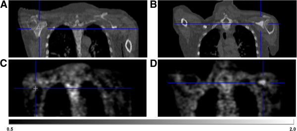 Illustration of increased 18F-MK-9470 binding 3 h p.i. in a metastatic lesion of the left scapula. CT demonstrates normal bone of the right scapula (A) and bone metastasis in the left scapula (B). As compared with the uptake in contralateral bone (C), 18F-MK-9470 PET 3 h p.i. demonstrates increased uptake in the lesion of the left scapula (D). Data are scaled from 0.5 to 2 SUV.