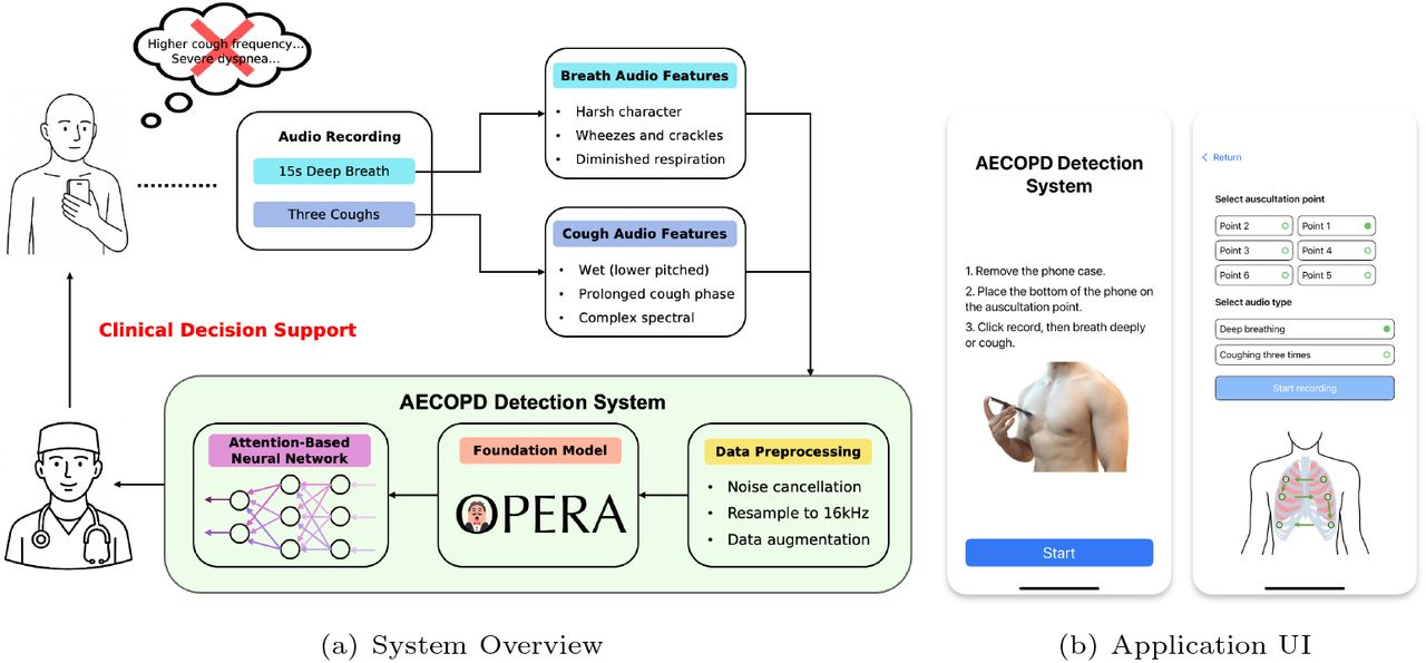 AI-System Overview and Usage Process.(a) Overall system architecture diagram. The process starts with recording the patient’s breathing and coughing audio, and then extracting key acoustic features from them. After preprocessing, these data are input into a neural network based on the attention mechanism and the OPERA basic model for analysis, ultimately providing doctors with clinical decision support for AECOPD treatment. (b) The user interface of the smartphone application for audio collection. The interface design is simple and the operation instructions are clear (such as selecting auscultation points, selecting audio types), demonstrating the ease of use of the tool.