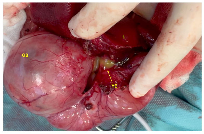 Yellow exudate (YE) from the gallbladder (GB) and liver (L).