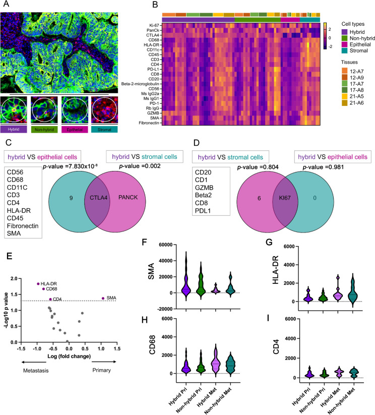Differential protein expression of THC (hybrid cells) in primary CRC and liver metastases. (A) Representative image of primary CRC tissues stained by immunofluorescence with selected ROIs, hybrid cells, tumor-immune cells (non-hybrid cells), epithelial cells and stromal cells; scale bars 500 and 150 μm (B) Heatmap for 21 proteins (rows) from the GeoMx immune cell profiling panel are clustered by downregulation (pink) and upregulation (yellow) among hybrid cells, non-hybrid cells, epithelial cells, and stromal cells (column). Six FFPE samples from three patients 12, 17 and 21 were also clustered (column) (C) Venn diagram showing contrast, CTLA4 upregulation in hybrid cells (p value = 7.830 × 10–8 and 0.002 for comparing to epithelial and stromal cells, respectively). (D) Venn diagram showing upregulation of KI67 in hybrid cells without significant difference from epithelial cells and stromal cells (p value = 0.804 and 0.981 for comparing to epithelial and stromal cells, respectively). (E) Volcano plot of 18 proteins comparing hybrid cells between primary CRC and liver metastatic tissues (F) Violin plot of SMA (G) HLA-DR (H) CD68 (I) CD4 hybrid cells and non-hybrid cells for primary CRC and liver metastasis tissues. Volcano plots were created with a log2 fold change and an adjusted p value at 0.05 for cut-off. The p value were determined by Mann–Whitney U test or the T test