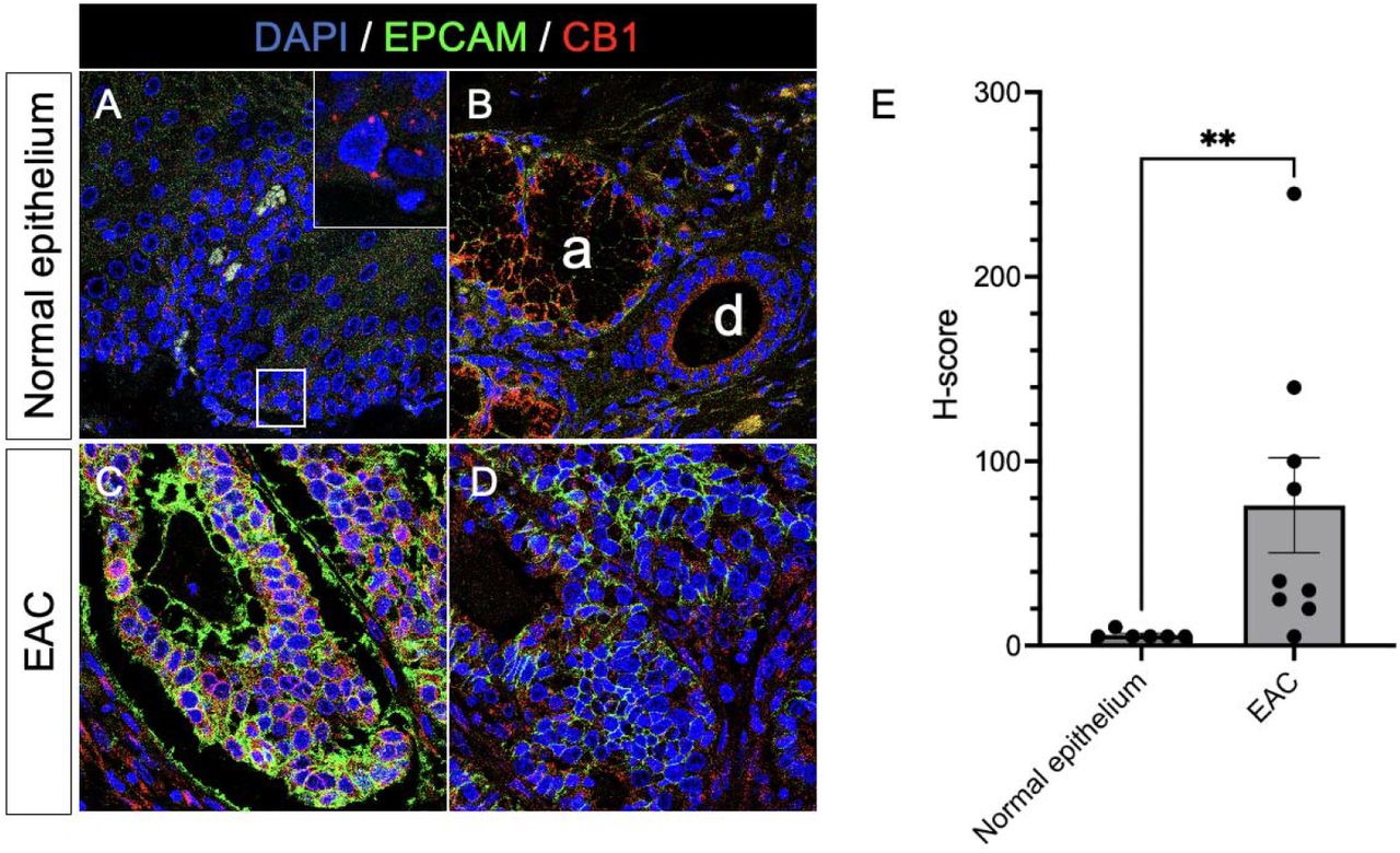 Expression of CB1 in human normal esophageal mucosa and EAC assessed by confocal microscopy.(A)A representative immunofluorescence analysis of CB1 (red) and EPCAM (green) expression in the normal human esophageal mucosa (Magnification 63x). The inset highlights the CB1 expression in the basal epithelial layer.(B)A representative immunofluorescence analysis depicting CB1 and EPCAM co-expression in the ductal epithelium of the submucosal gland (d) and acini of the submucosal gland (a).(C&D)Representative immunofluorescence analyses of CB1 and EPCAM co-expression in two distinct human EAC samples.(E)Bar graph represents a comparative H-score semiquantitative intensity analysis of CB1 expression in human normal esophageal mucosa and EAC. The data were analyzed using the Mann-Whitney U test. ** p < 0.01.