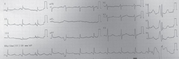 Normal sinus rhythm detected in the patient's ECG after 4 h of observation (body temperature, 35.7°C)