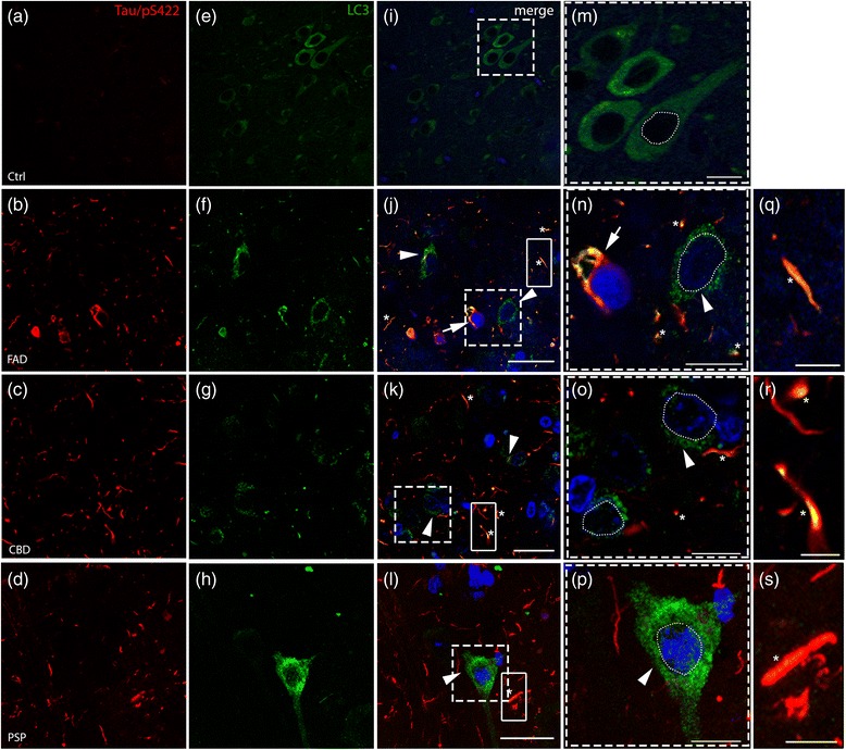 Accumulation of autophagic marker (LC3) and colocalization with hyperphosphorylated tau (Tau/pS422). Double immunofluorescence analysis on post-mortem tissues against (a-d) Tau/pS422 (red) and (e-h) LC3 (green). j-p Nuclei are stained with DAPI (blue, outlined with a white dashed line) in the merged pictures. e In control samples, LC3 staining is diffuse in the cytoplasm and LC3-positive dots are rarely observed (high magnification in (m) of the boxed area in i). j-l Arrowheads (and high magnifications, n-p) indicate cells showing accumulation of LC3 positive puncta in the perinuclear cytoplasm in FAD, CBD and PSP patients. Asterisks show colocalization in threads. In addition, FAD shows colocalization in tangle-like structures (j, n, arrows, see also SF. 2). q-s High magnification of the boxed areas in j-l showing colocalization of Tau/pS422 and LC3 in threads, respectively in FAD, CBD and PSP. Scale bars indicate 50 μm (i) and 25 μm (j-l); high magnification 10 μm (m-p) and 5 μm (q-s)